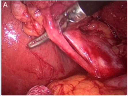 Cystic artery anterior to cystic duct