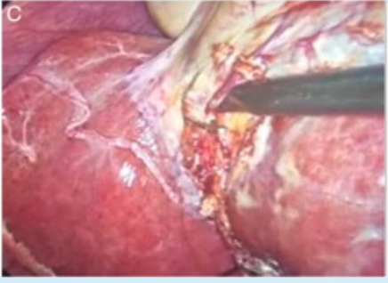 Cystic artery from liver parenchyma