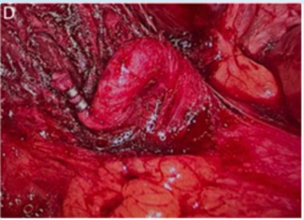 Cystic artery hump variant