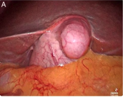 Gallbladder diverticulum