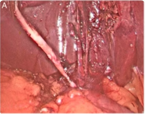 Long cystic duct