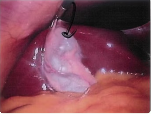 Normal cystic duct
