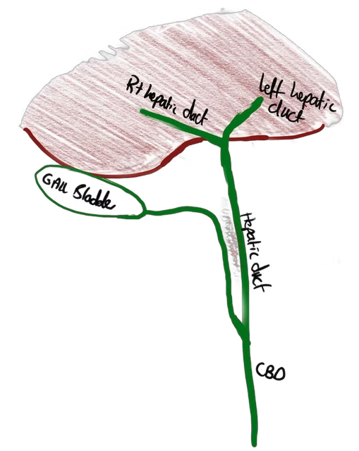 Parallel cystic duct 20%