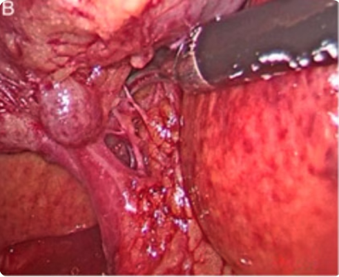 Spiral cystic duct 10%