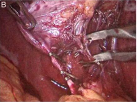 Double cystic artery