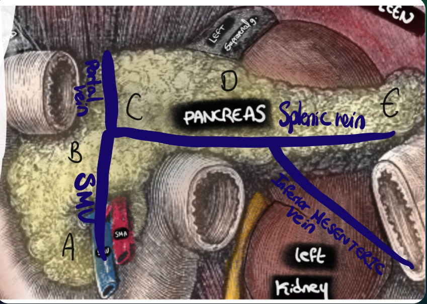 Formation of the portal vein posterior to the pancreas