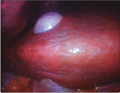 Intrahepatic gallbladder