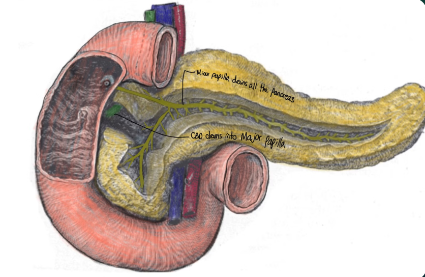Type 2 pancreatic divisum