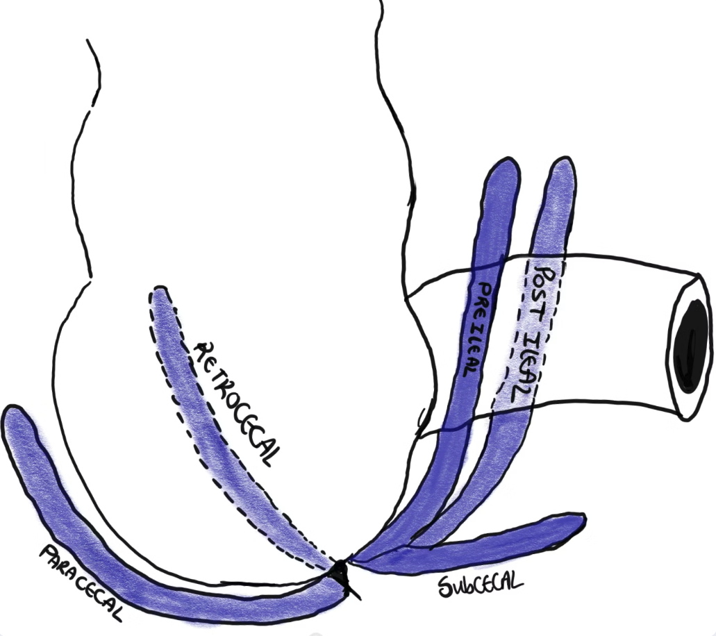 Appendix tip positions diagram